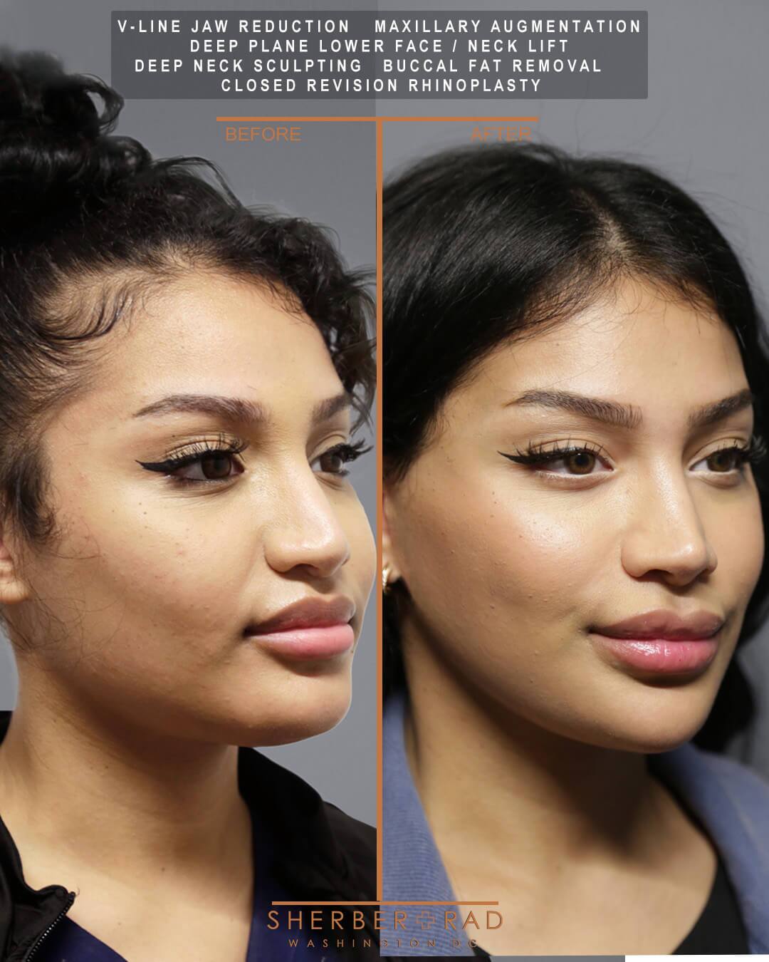 Jaw Reduction before and after photos by Sherber and Rad in Washington DC