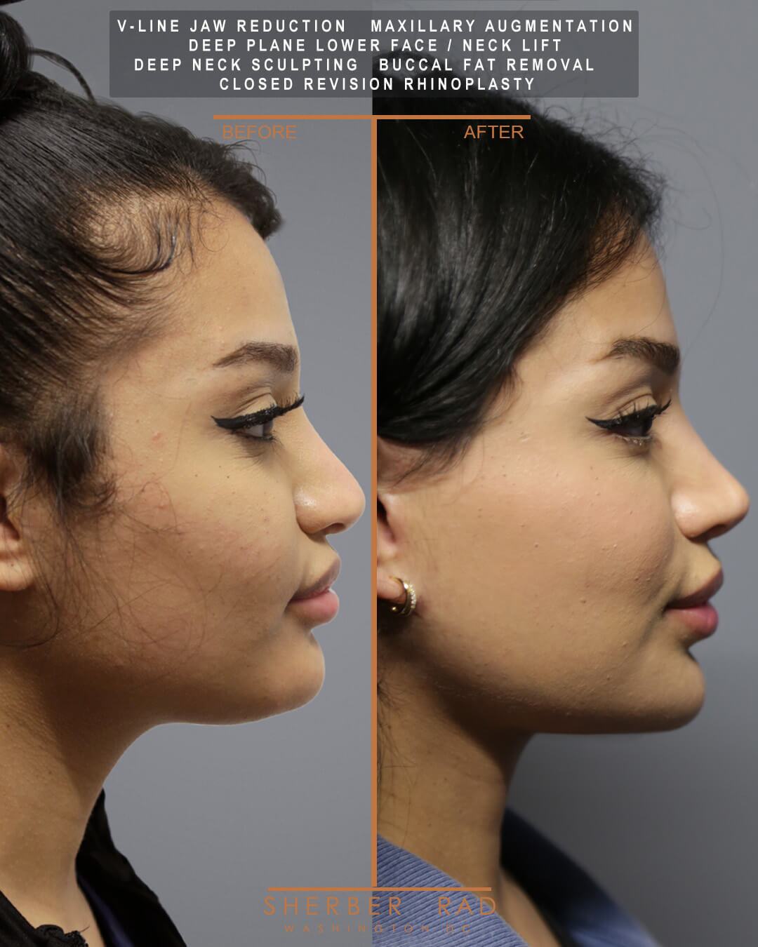 Jaw Reduction before and after photos by Sherber and Rad in Washington DC