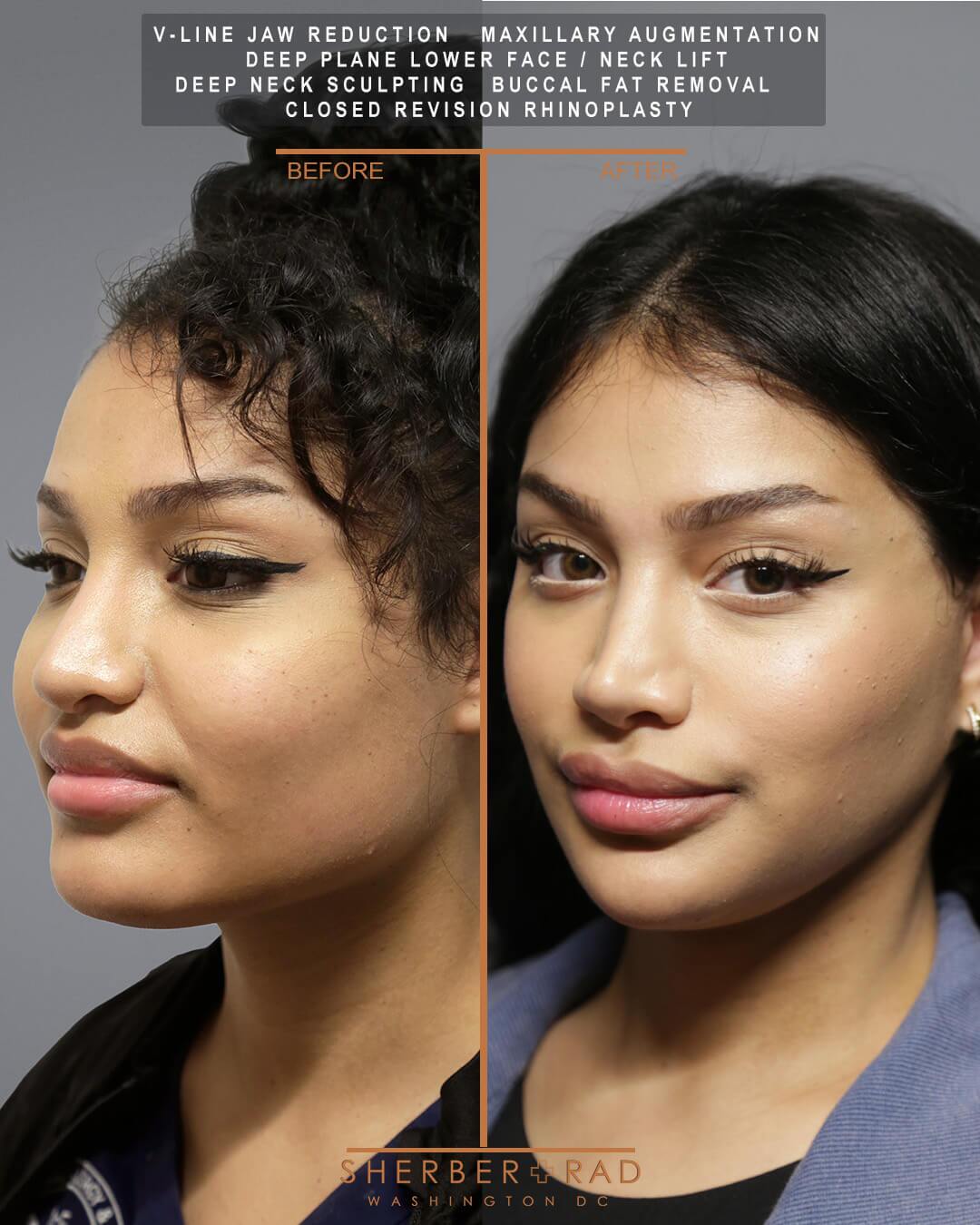 Jaw Reduction before and after photos by Sherber and Rad in Washington DC