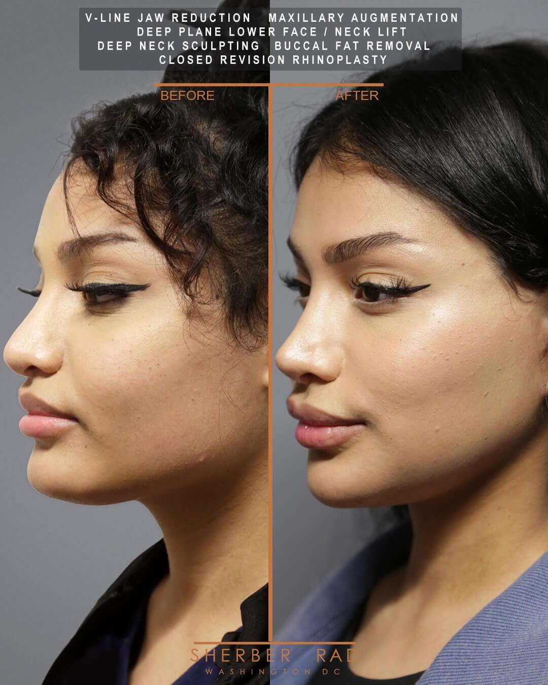 Jaw Reduction before and after photos by Sherber and Rad in Washington DC