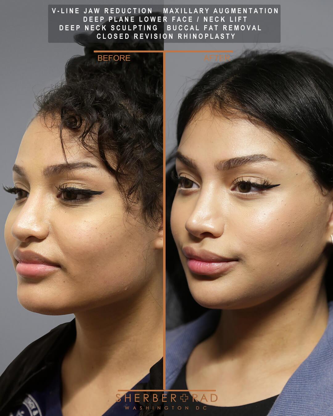 Jaw Reduction before and after photos by Sherber and Rad in Washington DC