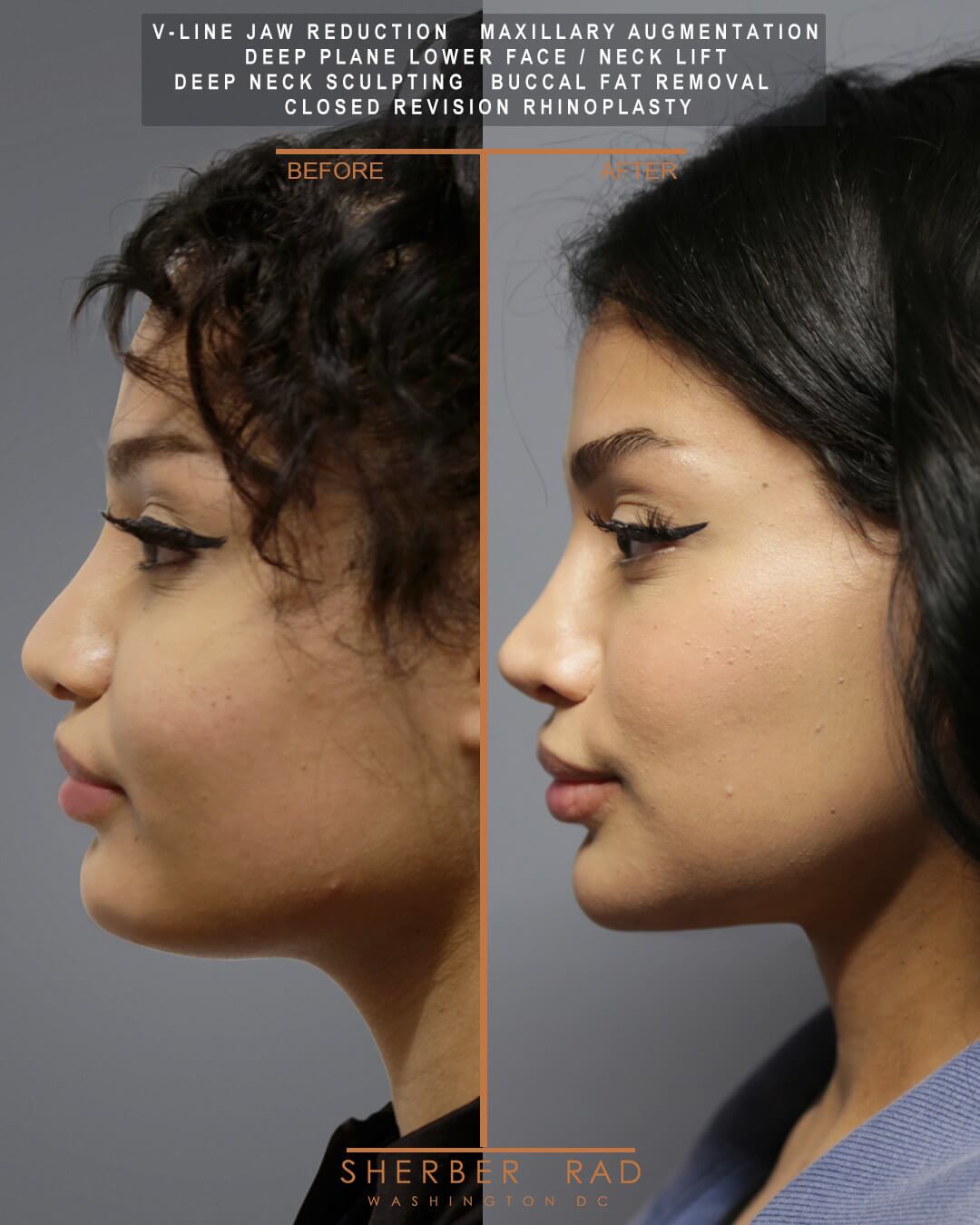 Jaw Reduction before and after photos by Sherber and Rad in Washington DC