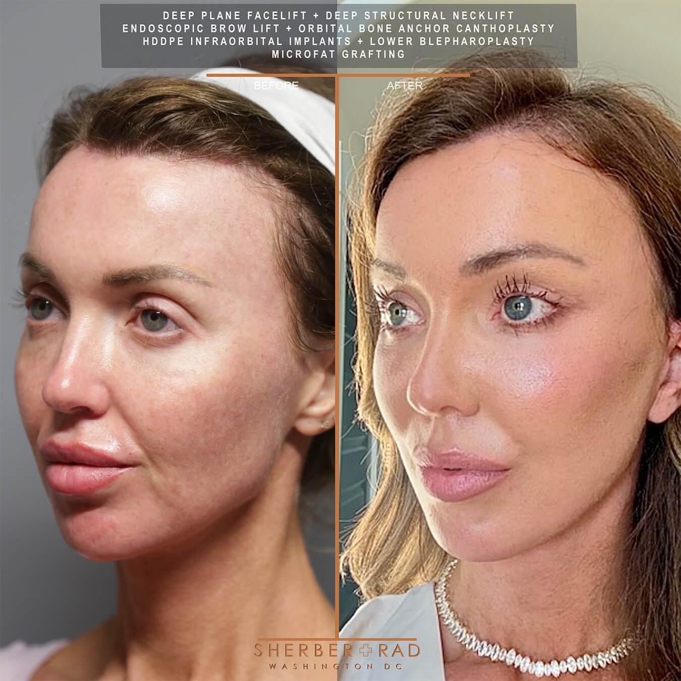 SMAS Facelift before and after photos by Sherber and Rad in Washington DC