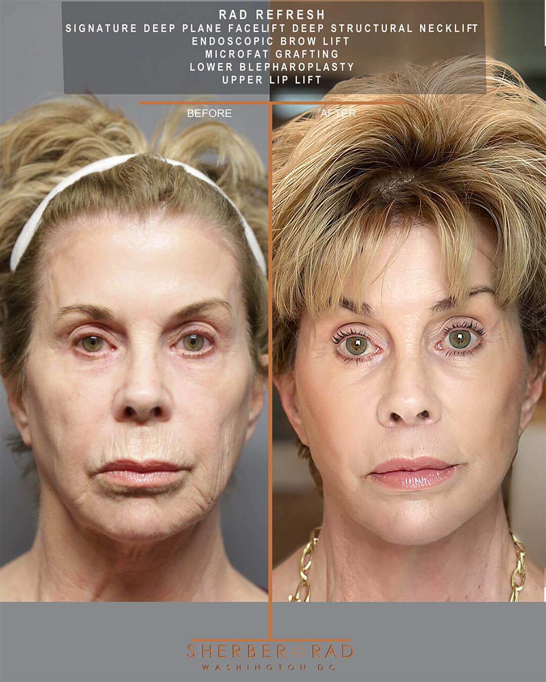 Deep Plane Facelift before and after photos by Sherber and Rad in Washington DC