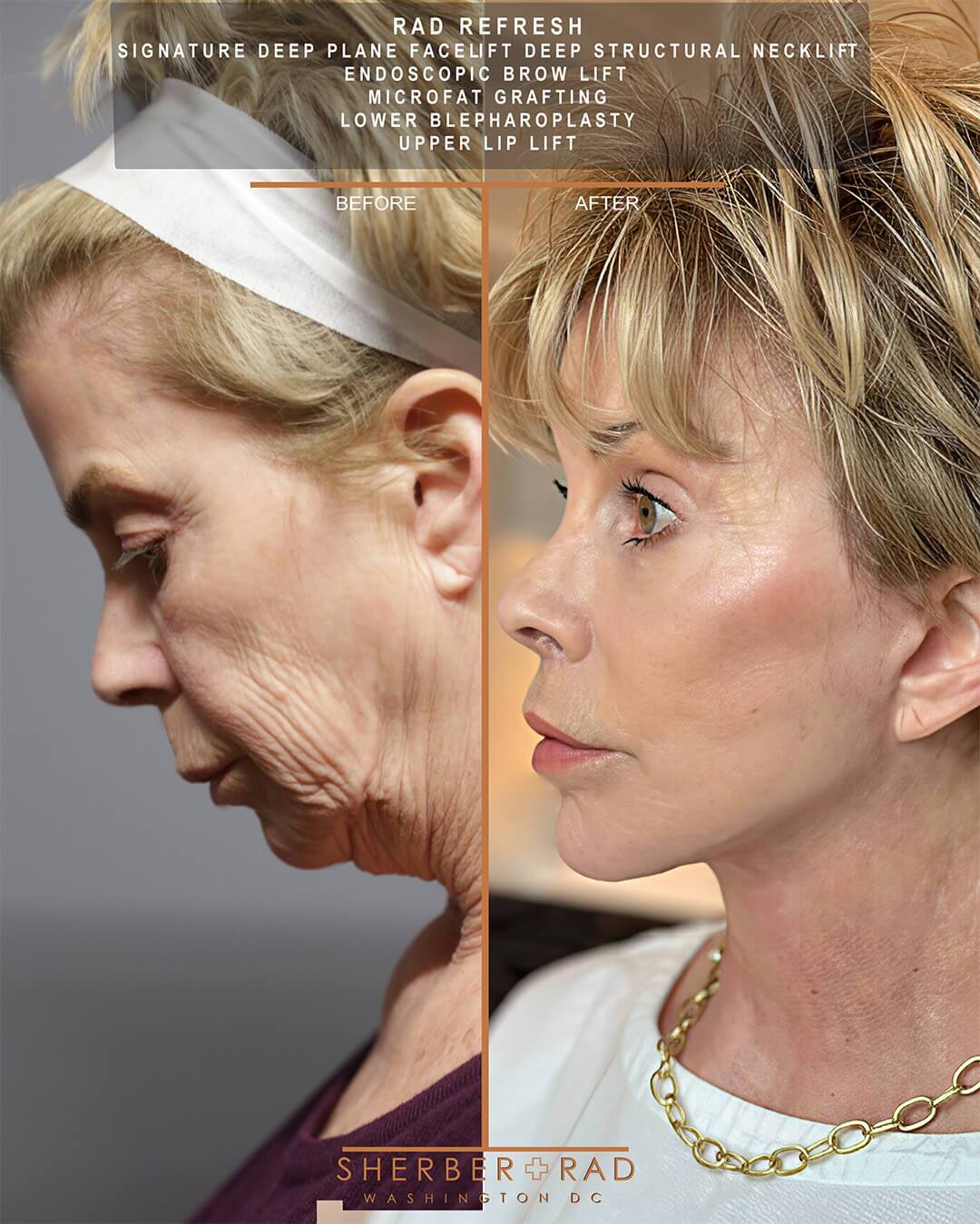 Deep Plane Facelift before and after photos by Sherber and Rad in Washington DC