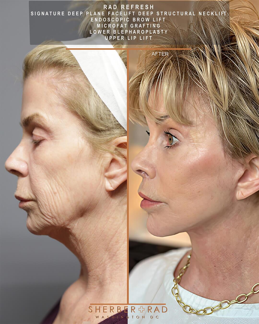 Deep Plane Facelift before and after photos by Sherber and Rad in Washington DC