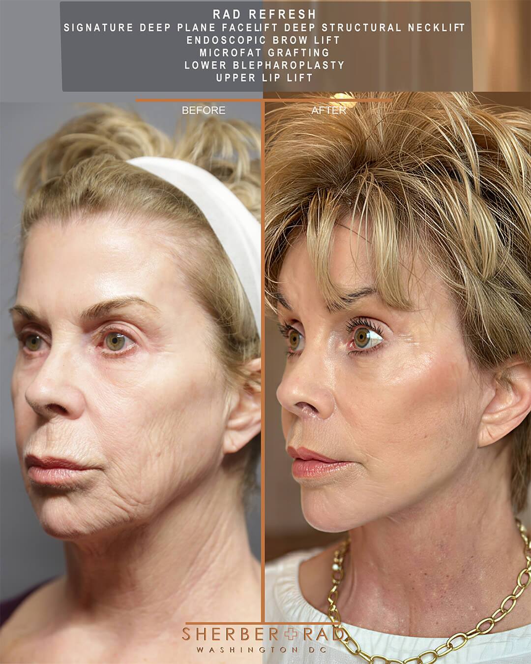 Deep Plane Facelift before and after photos by Sherber and Rad in Washington DC
