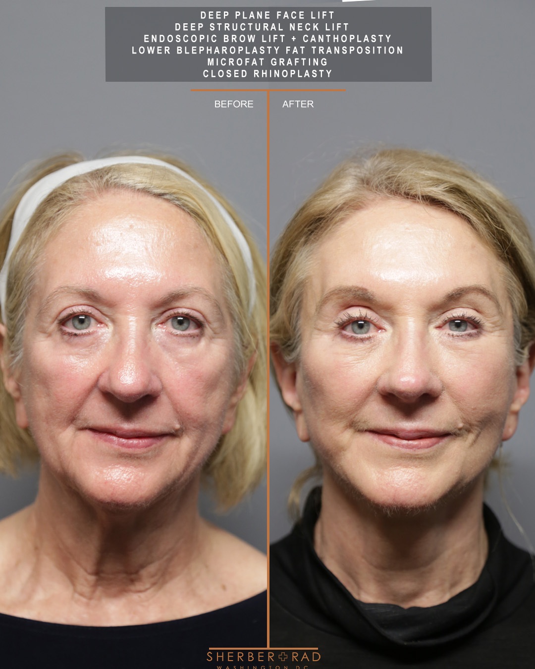 front view facelift browlift blepharoplasty fat grafting before and after photos by sherber and rad