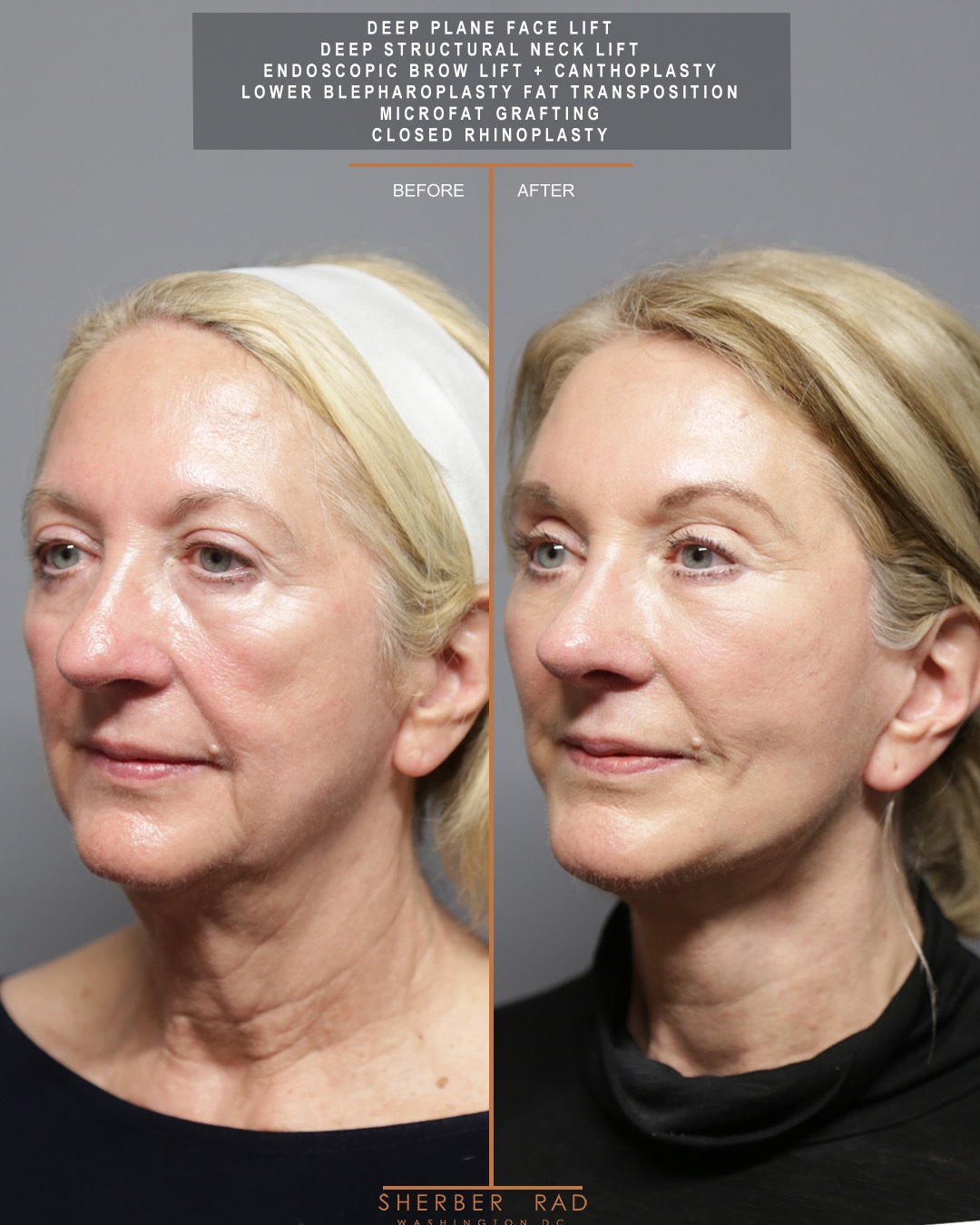 left oblique view facelift browlift blepharoplasty fat grafting before and after photos by sherber and rad