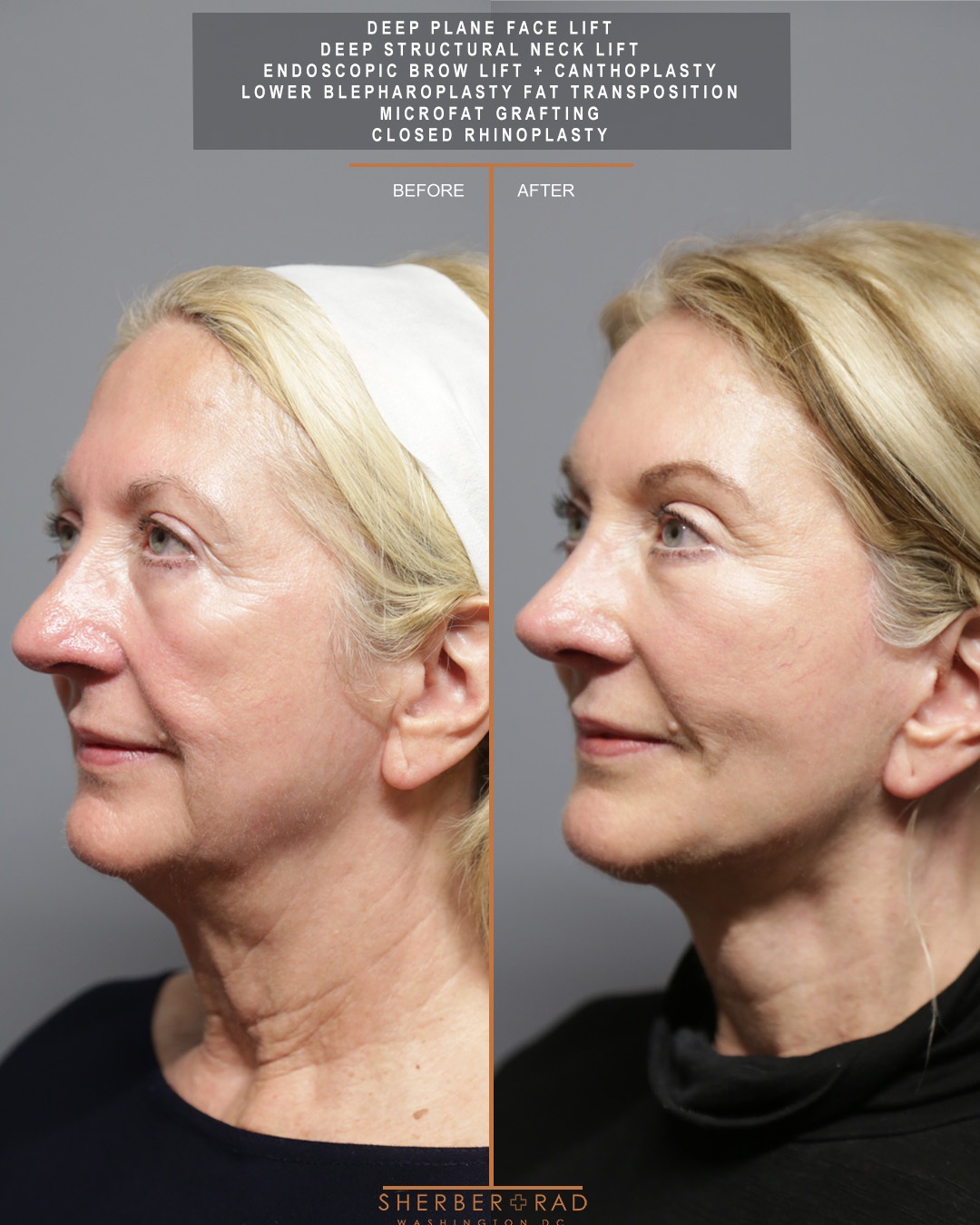left side view facelift browlift blepharoplasty fat grafting before and after photos by sherber and rad
