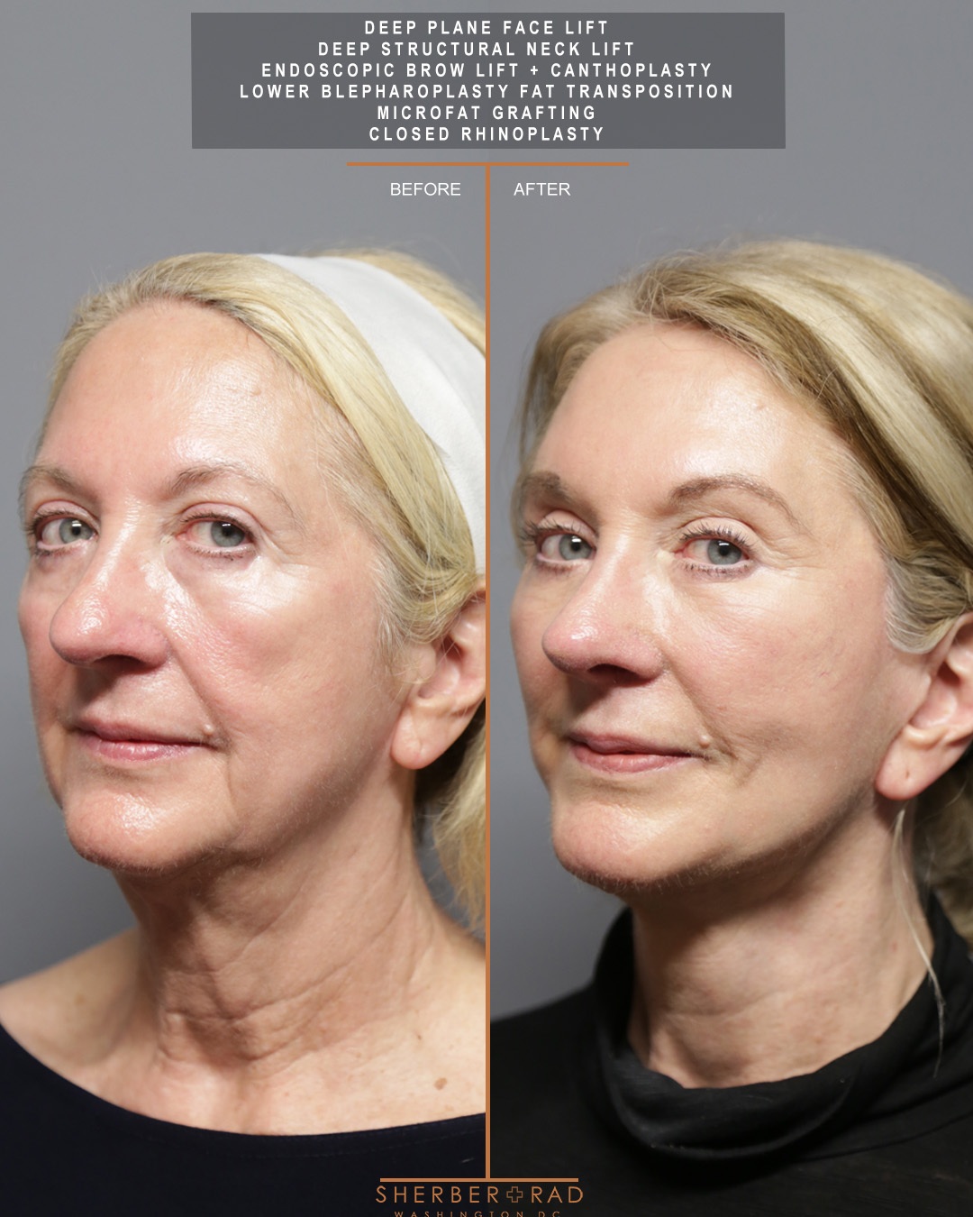 oblique left view facelift browlift blepharoplasty fat grafting before and after photos by sherber and rad