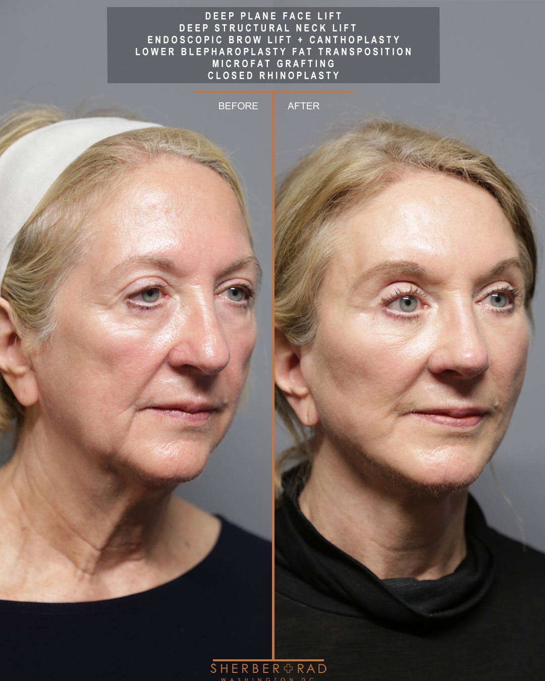 right oblique view facelift browlift blepharoplasty fat grafting before and after photos by sherber and rad