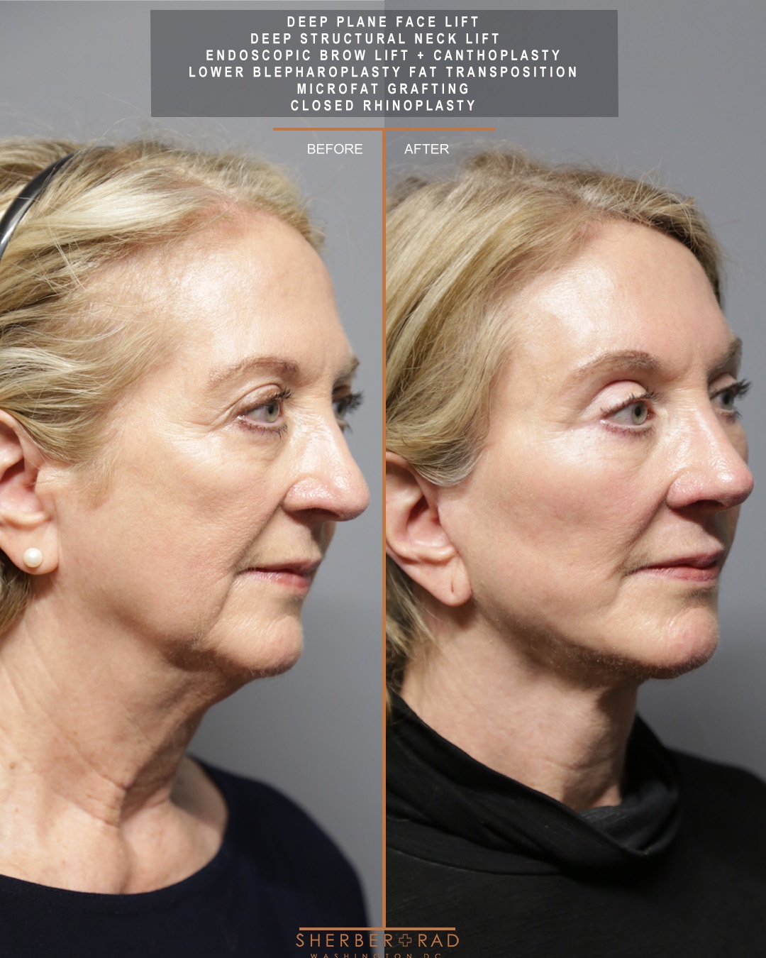right side view facelift browlift blepharoplasty fat grafting before and after photos by sherber and rad