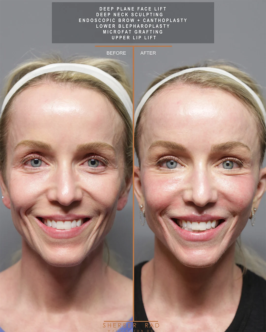 Facelift before and after photos by Sherber and Rad in Washington DC