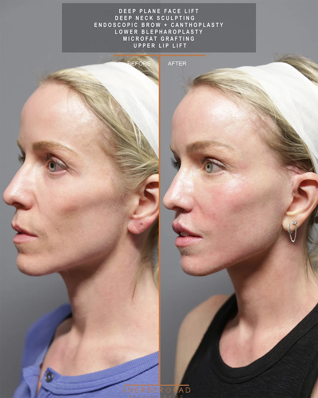 Facelift before and after photos by Sherber and Rad in Washington DC