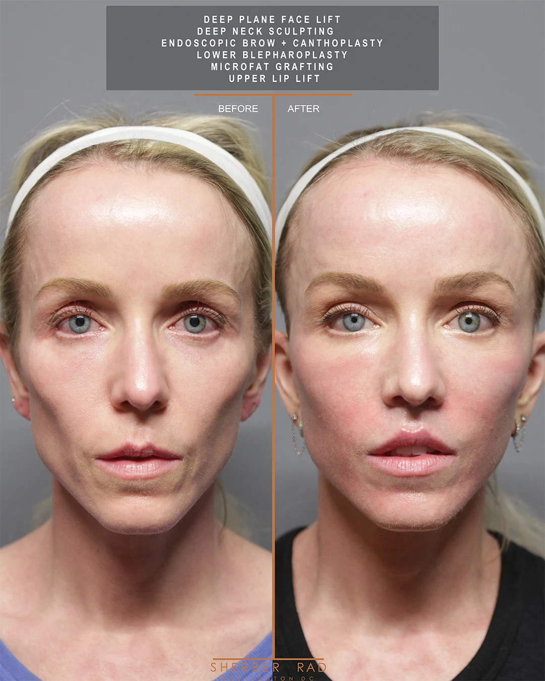 Facelift before and after photos by Sherber and Rad in Washington DC
