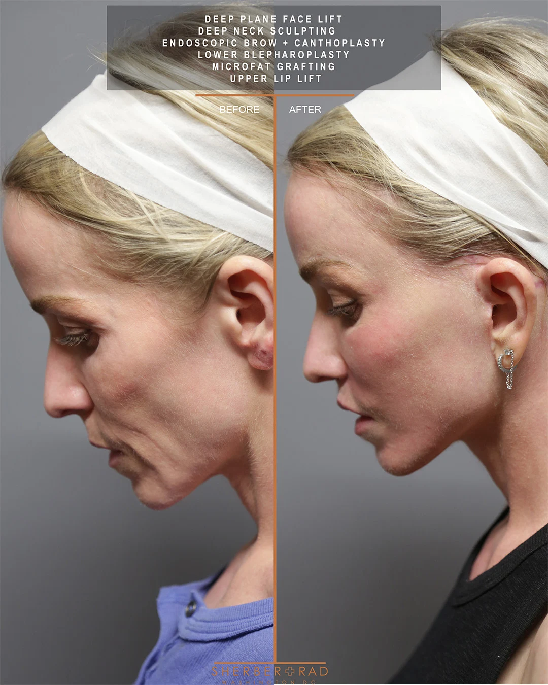 Facelift before and after photos by Sherber and Rad in Washington DC