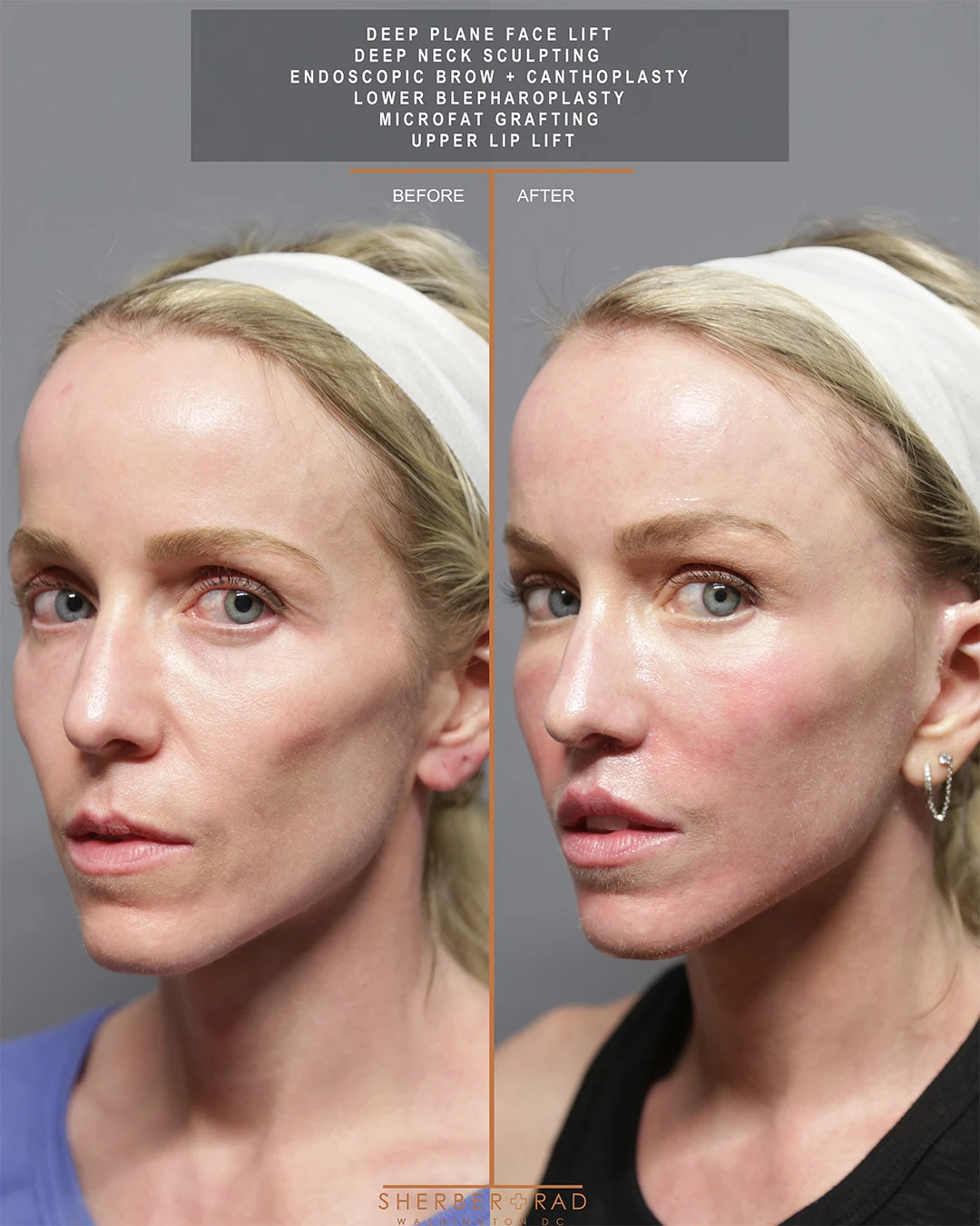 Facelift before and after photos by Sherber and Rad in Washington DC