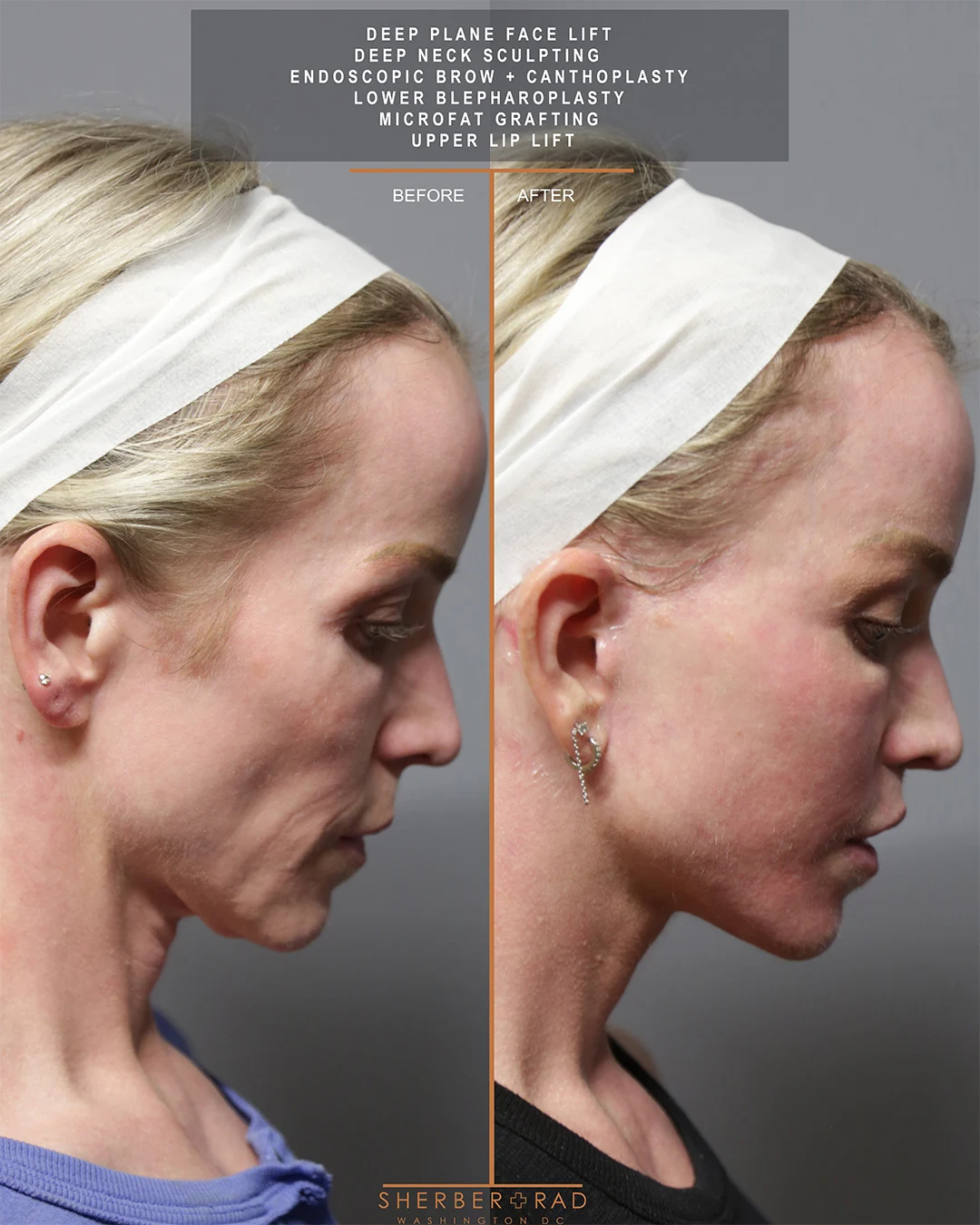 Facelift before and after photos by Sherber and Rad in Washington DC