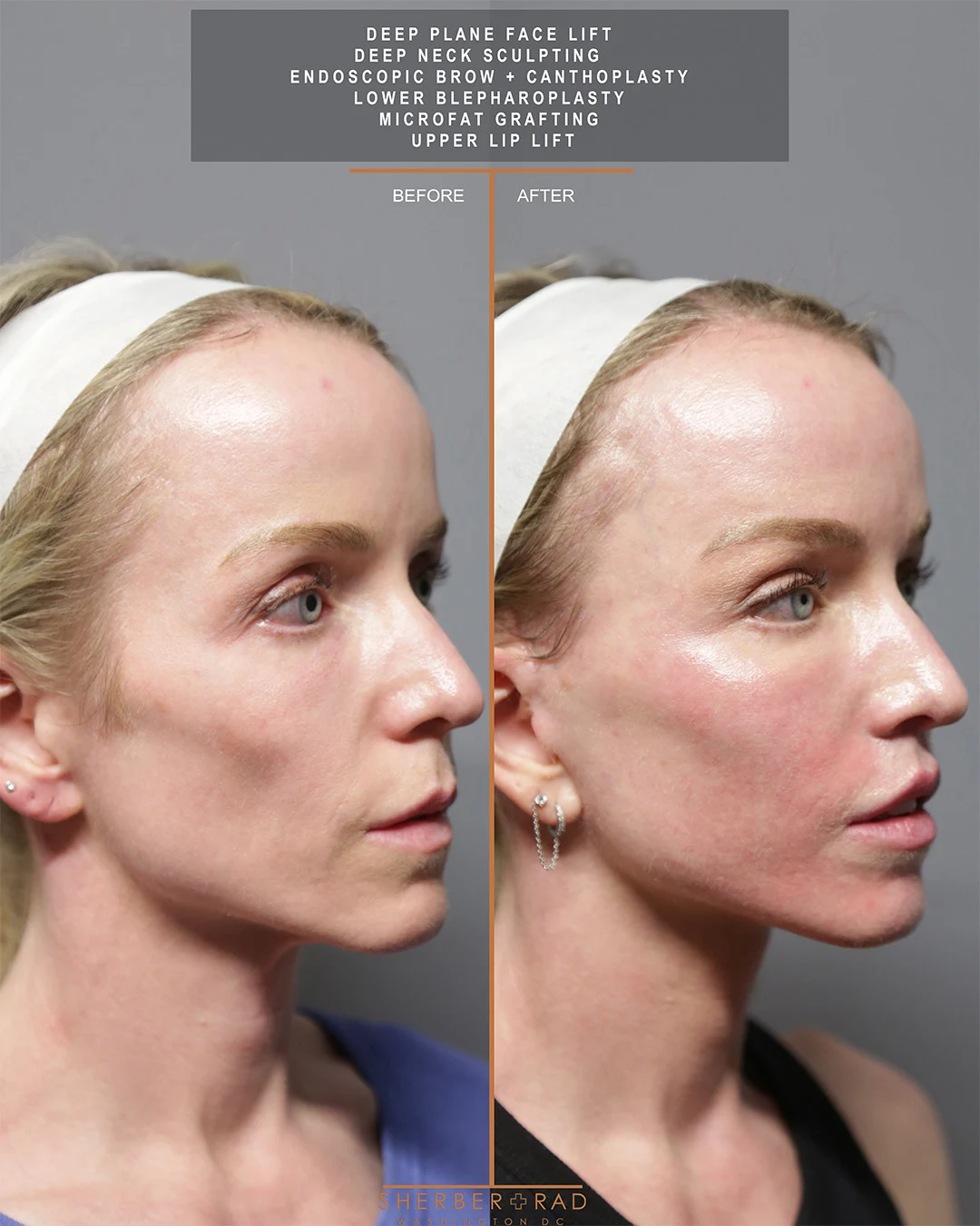Facelift before and after photos by Sherber and Rad in Washington DC