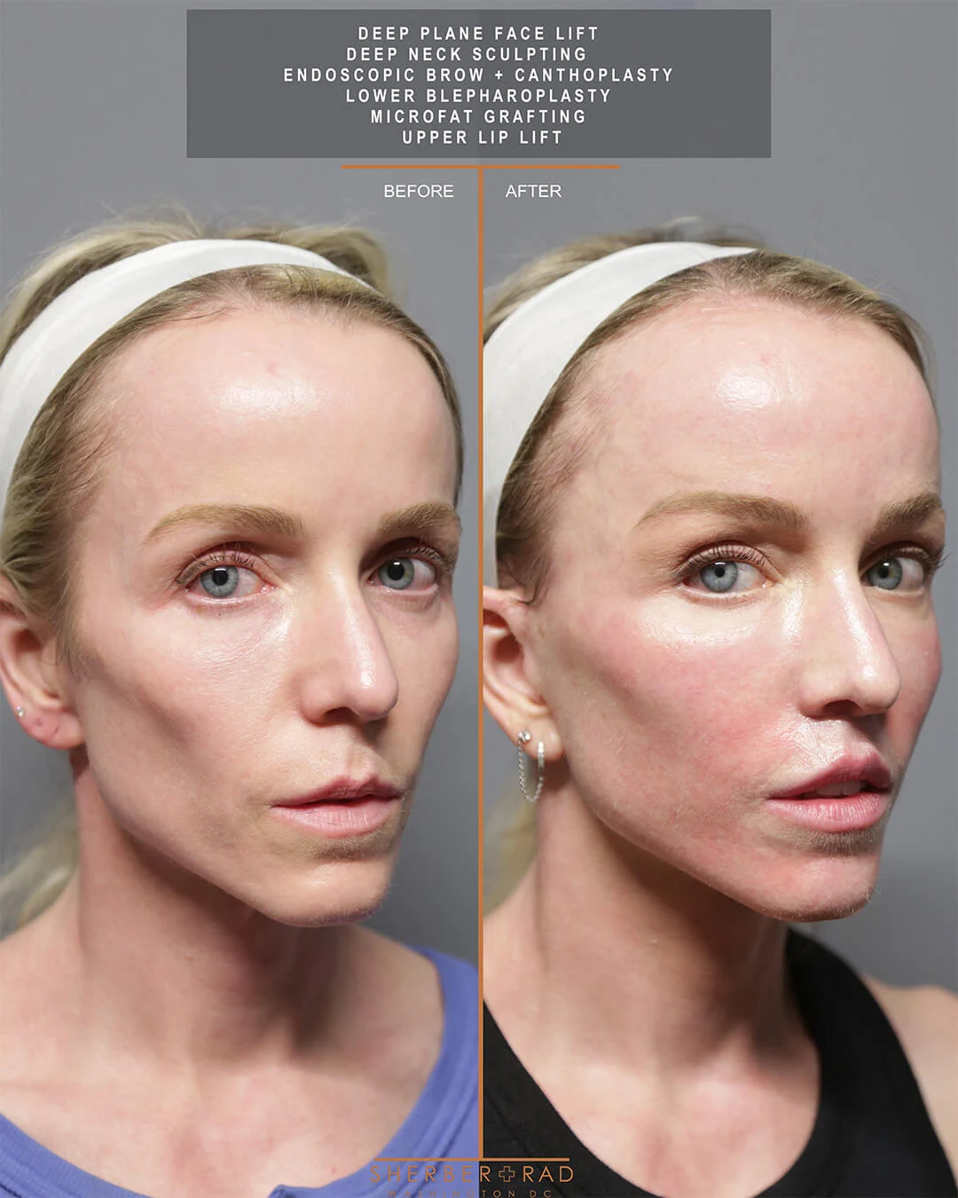 Facelift before and after photos by Sherber and Rad in Washington DC