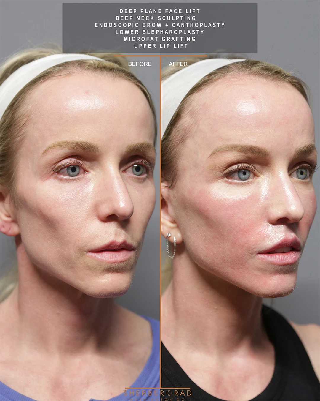Facelift before and after photos by Sherber and Rad in Washington DC