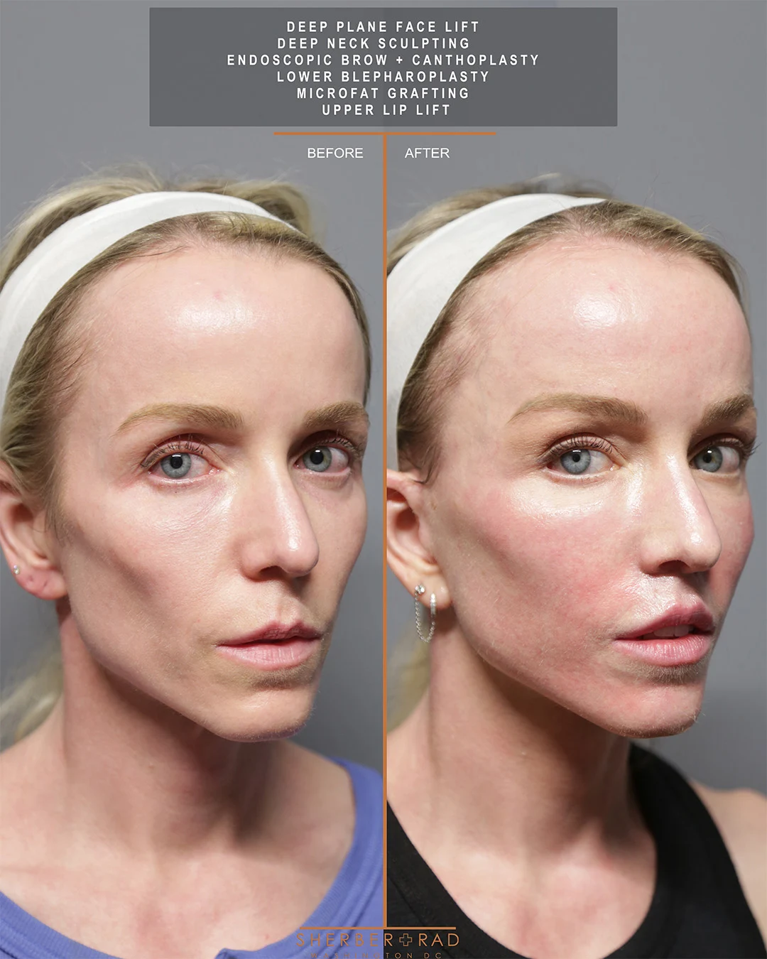 Facelift before and after photos by Sherber and Rad in Washington DC
