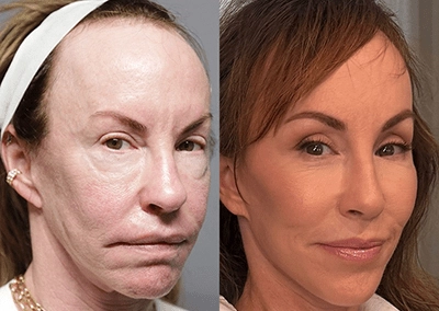 facelift browlift blepharoplasty fat grafting before and after photos by sherber and rad