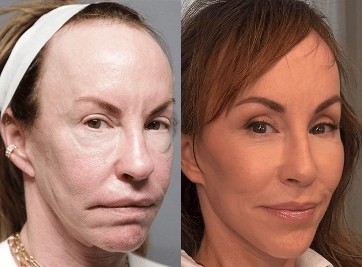 facelift browlift blepharoplasty fat grafting before and after photos by sherber and rad