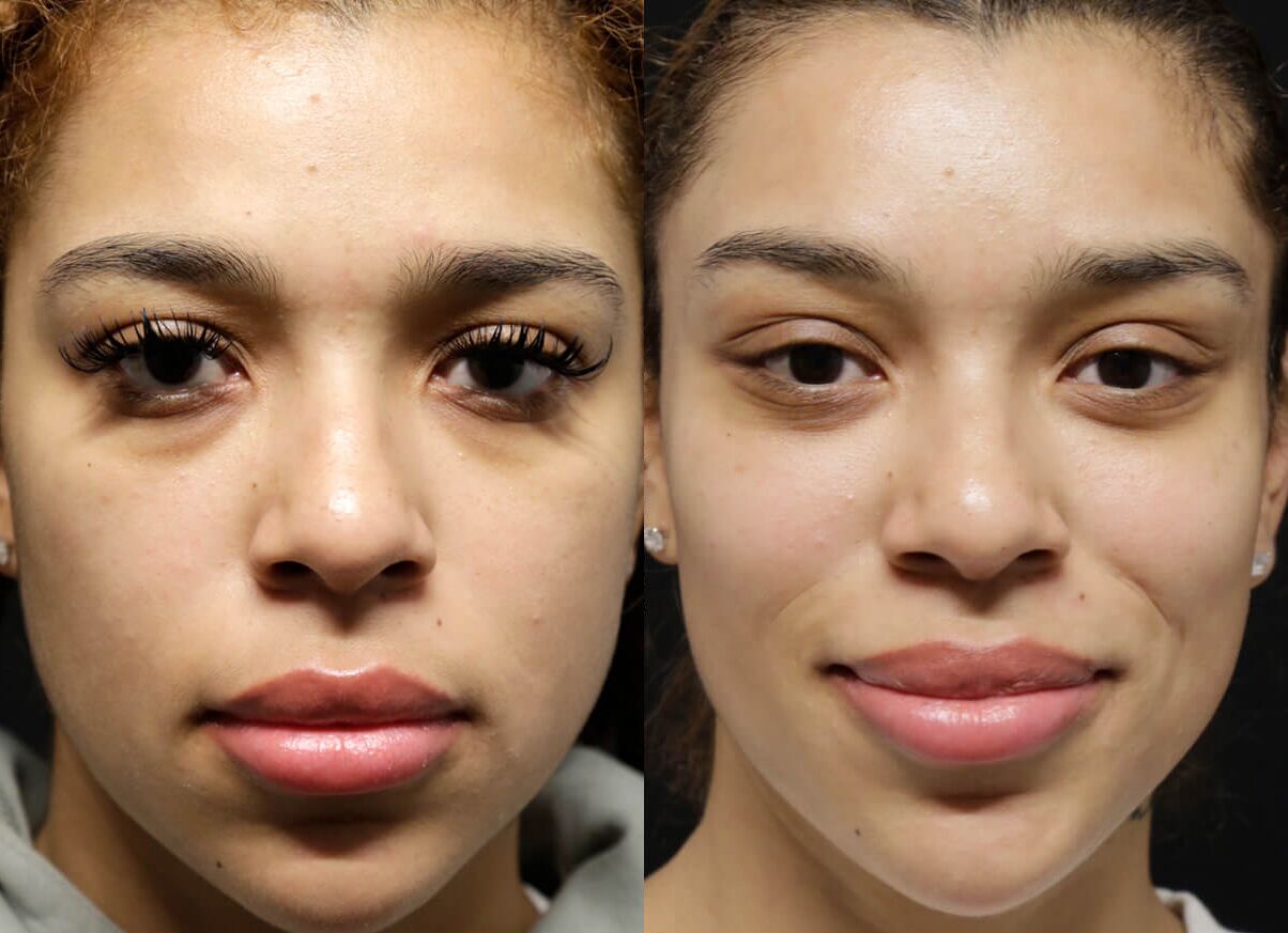 Brow + Forehead Lift before and after photos by Sherber and Rad in Washington, DC