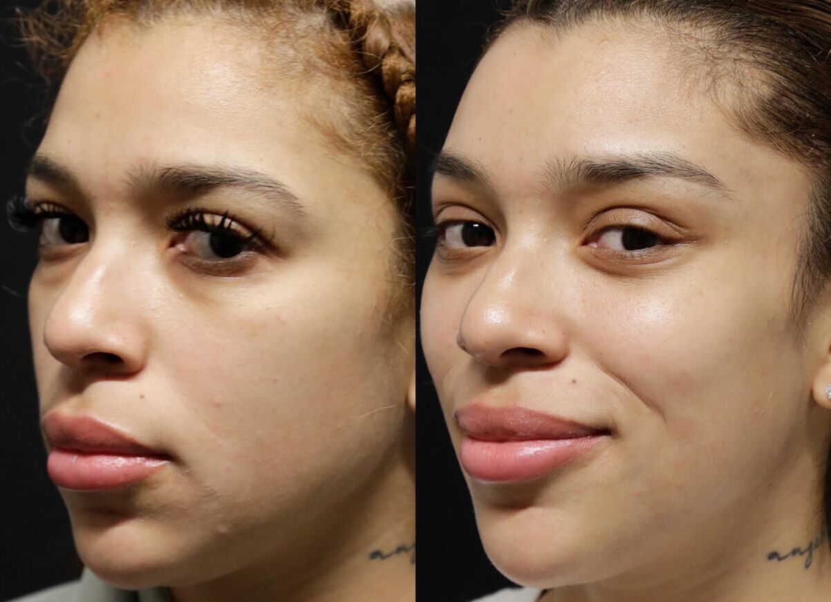 Brow + Forehead Lift before and after photos by Sherber and Rad in Washington, DC