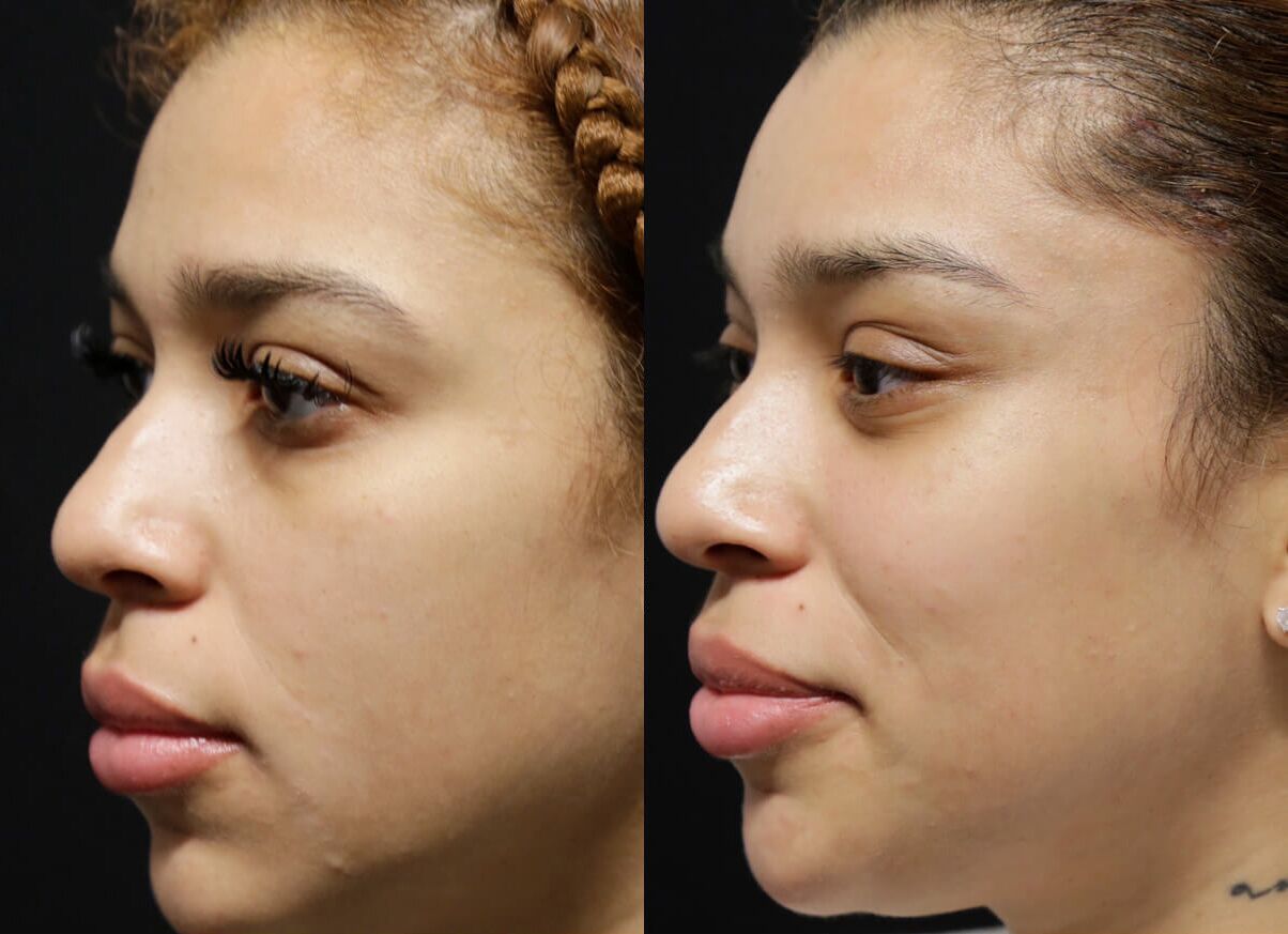 Brow + Forehead Lift before and after photos by Sherber and Rad in Washington, DC