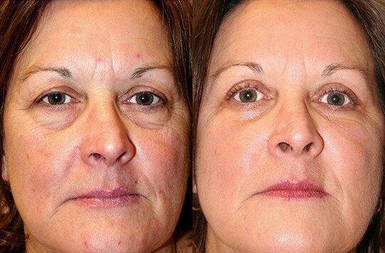 Female Eyelid Lift before and after photos by Sherber and Rad in Washington, DC