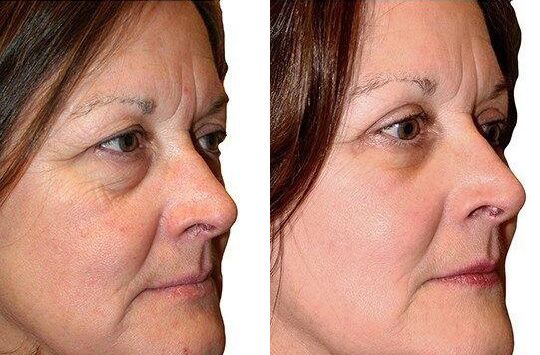 Female Eyelid Lift before and after photos by Sherber and Rad in Washington, DC