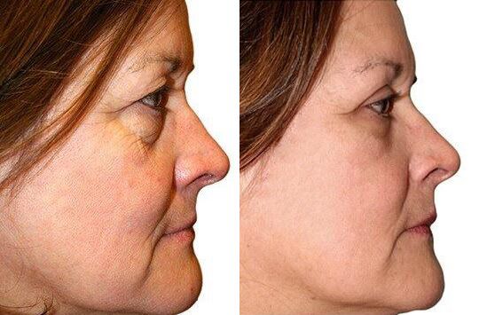 Female Eyelid Lift before and after photos by Sherber and Rad in Washington, DC