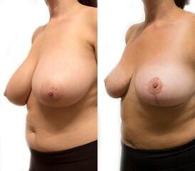 Breast Lift + Reduction before and after photos by Sherber and Rad in Washington, DC