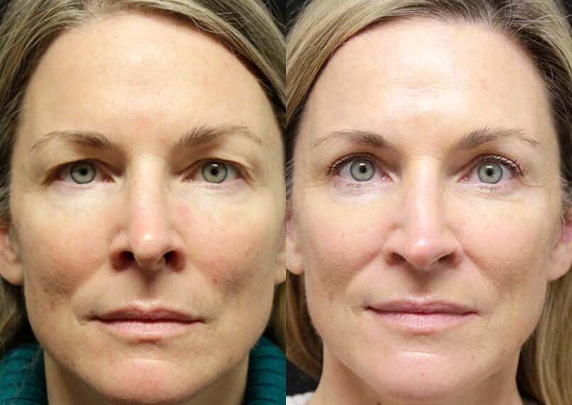 Female Eyelid Lift before and after photos by Sherber and Rad in Washington, DC