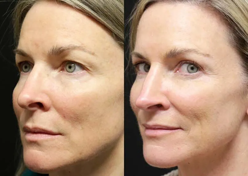 Female Eyelid Lift before and after photos by Sherber and Rad in Washington, DC