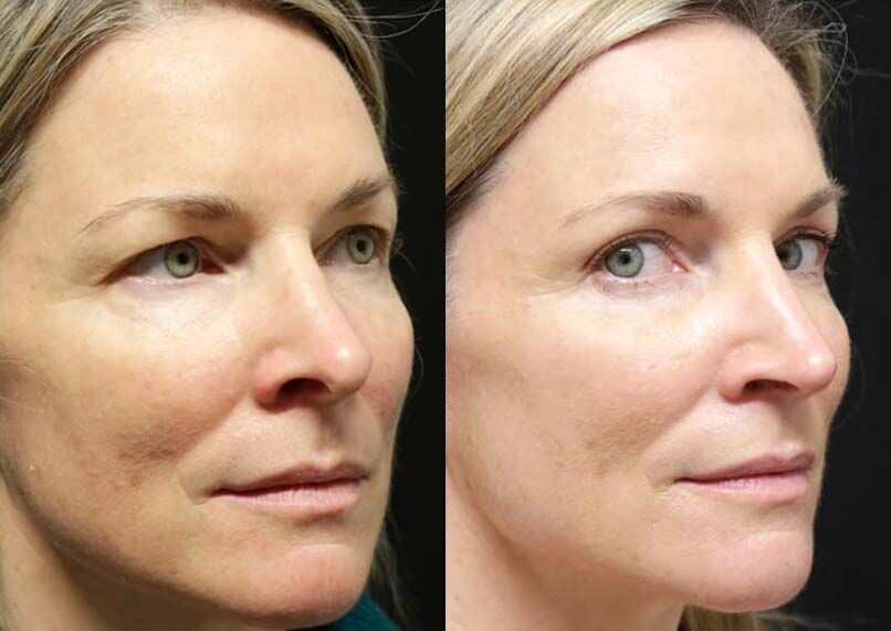 Female Eyelid Lift before and after photos by Sherber and Rad in Washington, DC