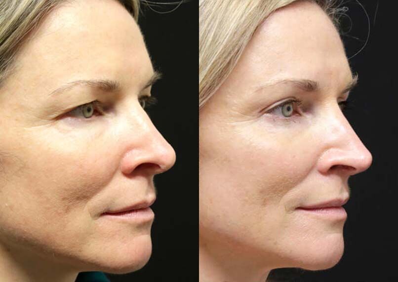 Female Eyelid Lift before and after photos by Sherber and Rad in Washington, DC