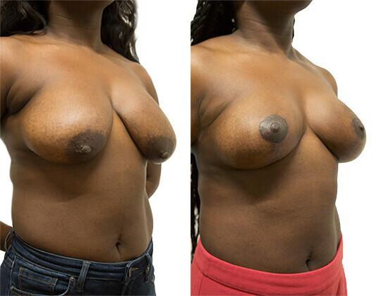 Breast Lift + Reduction before and after photos by Sherber and Rad in Washington, DC