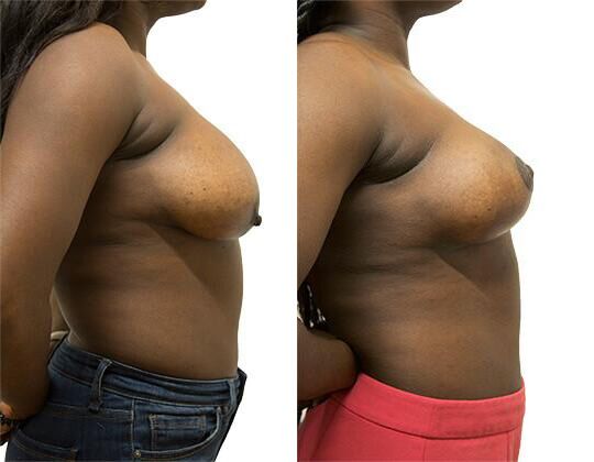 Breast Lift + Reduction before and after photos by Sherber and Rad in Washington, DC