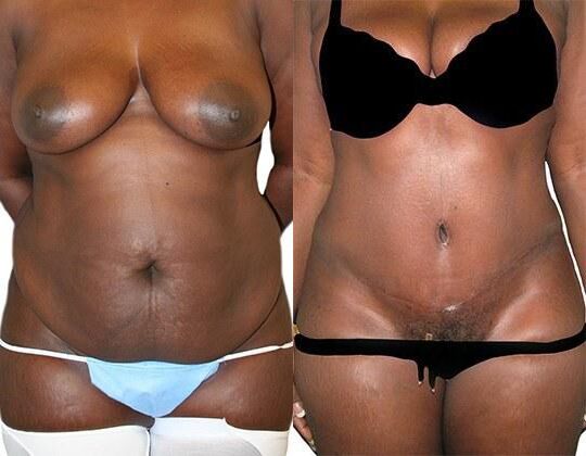 Tummy Tuck + Liposuction before and after photos by Sherber and Rad in Washington, DC