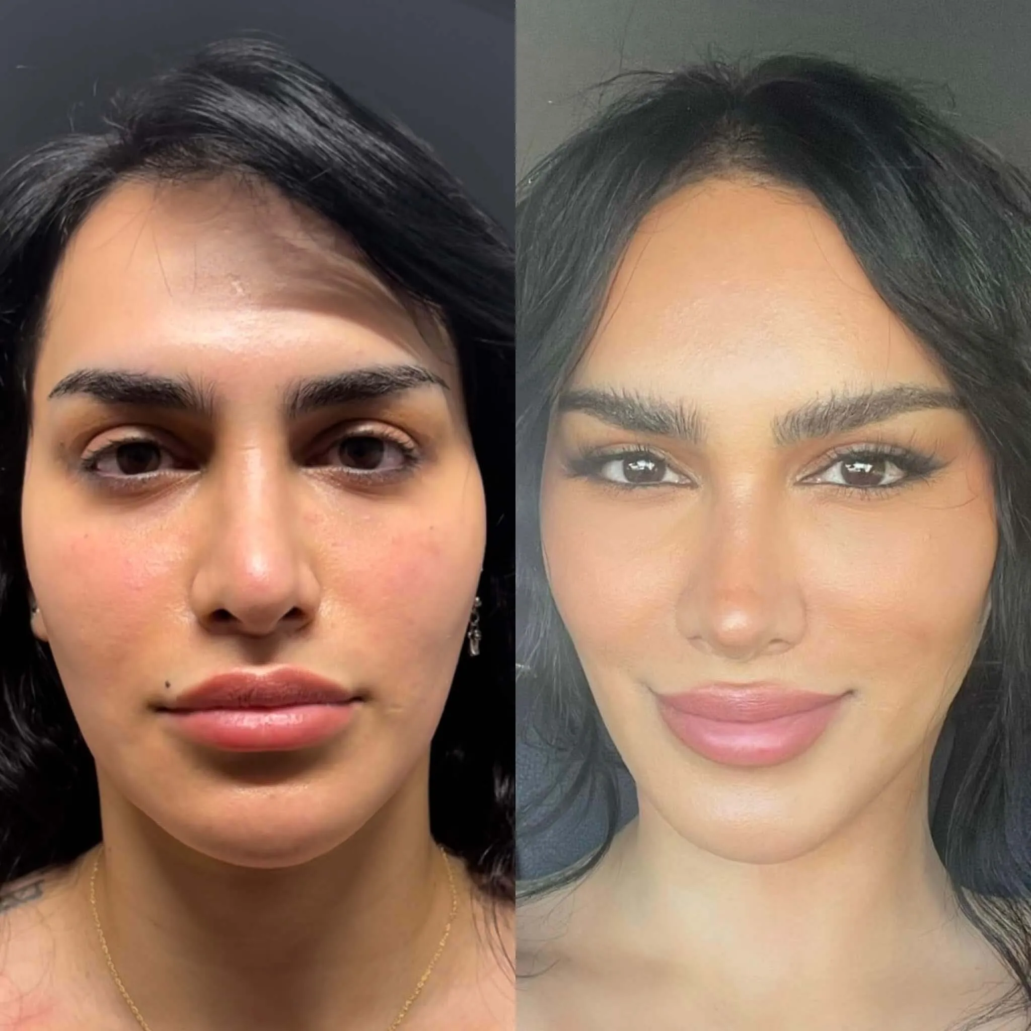Facelift before and after photos by Sherber and Rad in Washington, DC