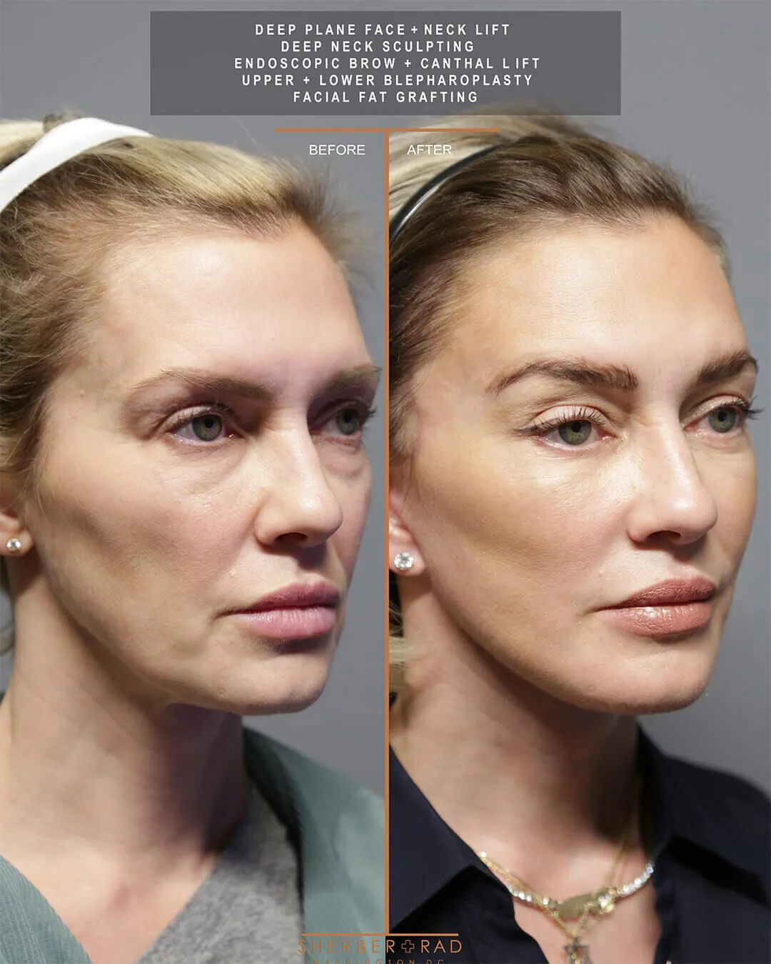 deep plane facelift before and after photos by sherber and rad in washington dc