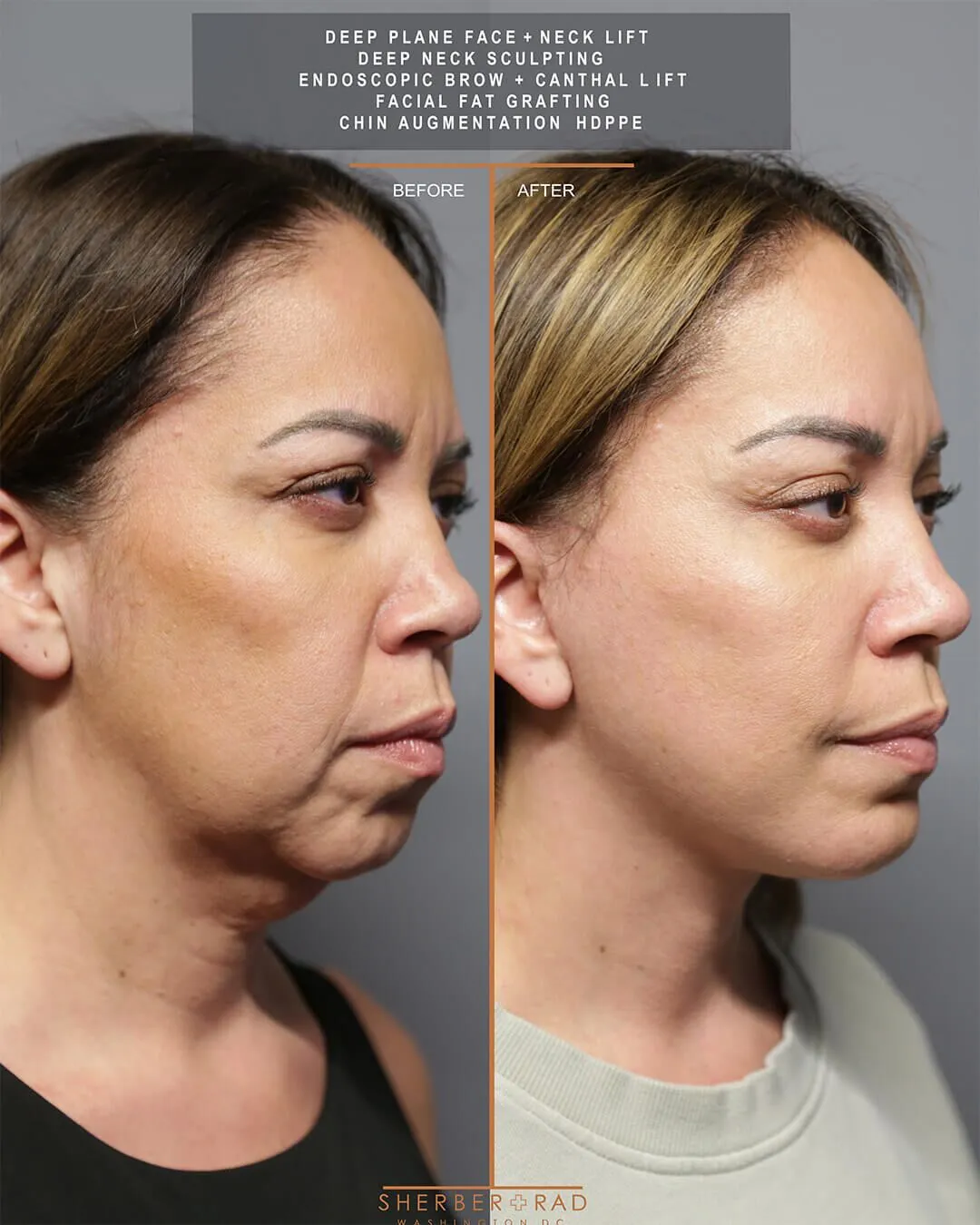 deep plane facelift before and after photos by sherber and rad in washington dc