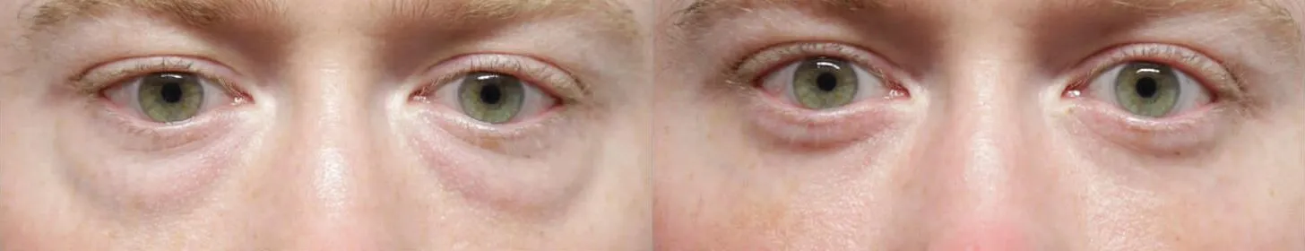 Facial Fat Transfer before and after photos by Sherber and Rad in Washington, DC