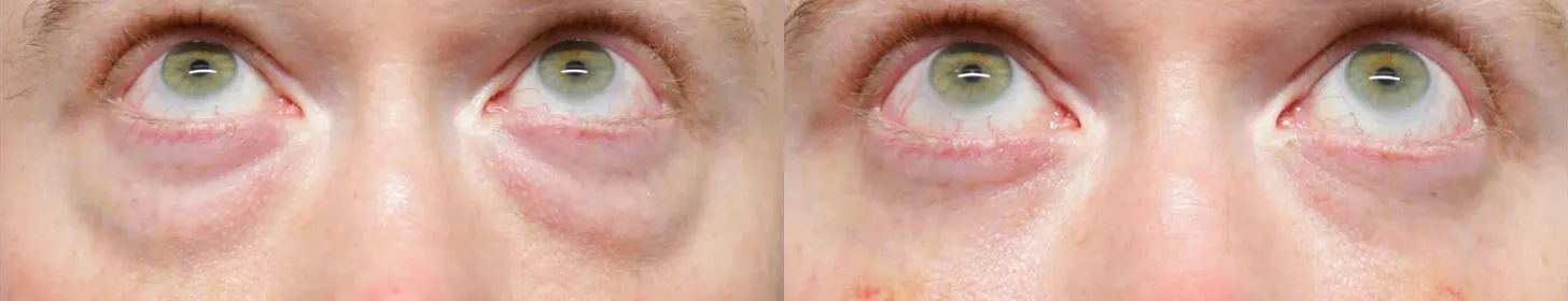 Facial Fat Transfer before and after photos by Sherber and Rad in Washington, DC