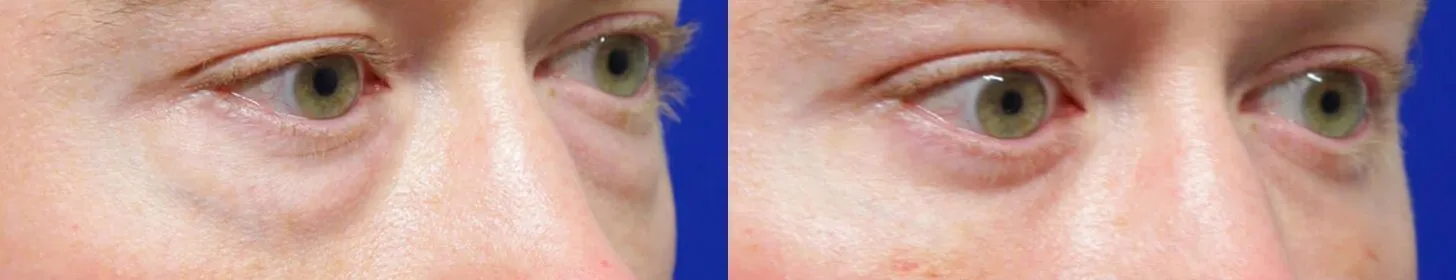 Facial Fat Transfer before and after photos by Sherber and Rad in Washington, DC