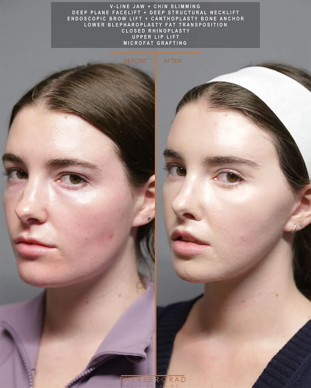Jaw Reduction before and after photos by Sherber and Rad in Washington DC